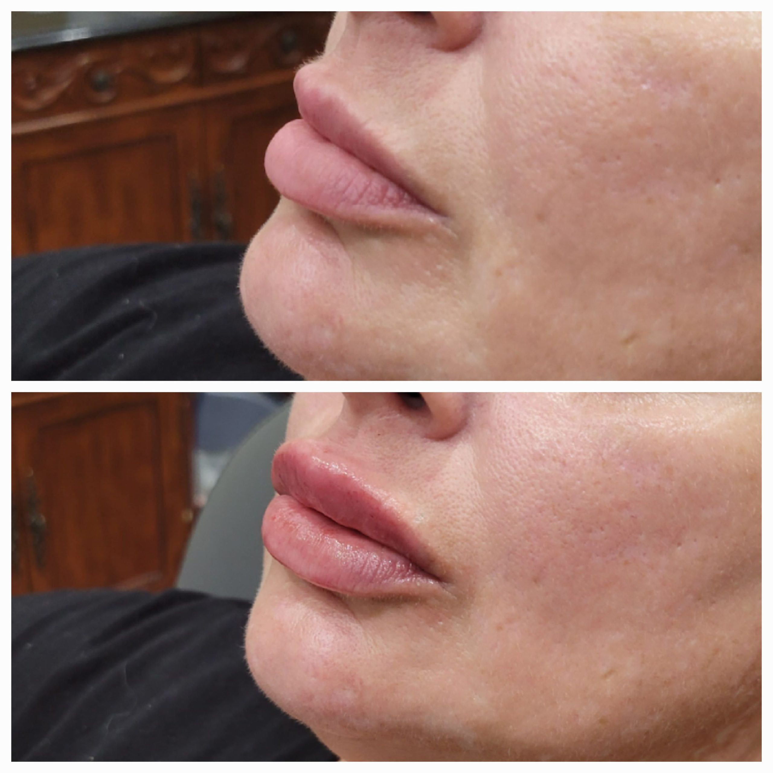 Lip filler _Russian_ style